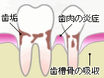 歯周病・歯槽膿漏3　歯周炎（軽度〜中等度）