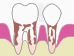歯周病・歯槽膿漏4　歯周病（重度）